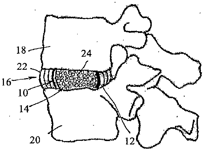 Intervertebral disc restoration