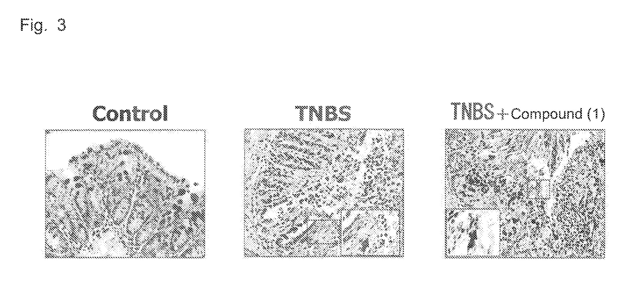 Therapeutic agent for inflammatory bowel disease