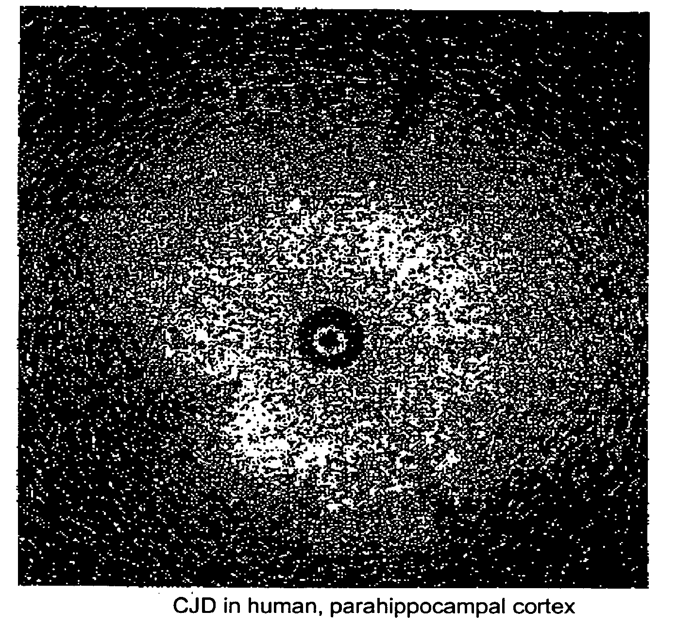 Method for rapid screening of mad cow disease and other transmissible spongiform encephalopathies