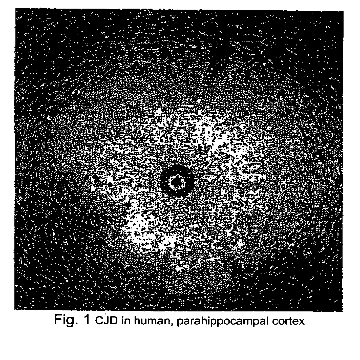 Method for rapid screening of mad cow disease and other transmissible spongiform encephalopathies