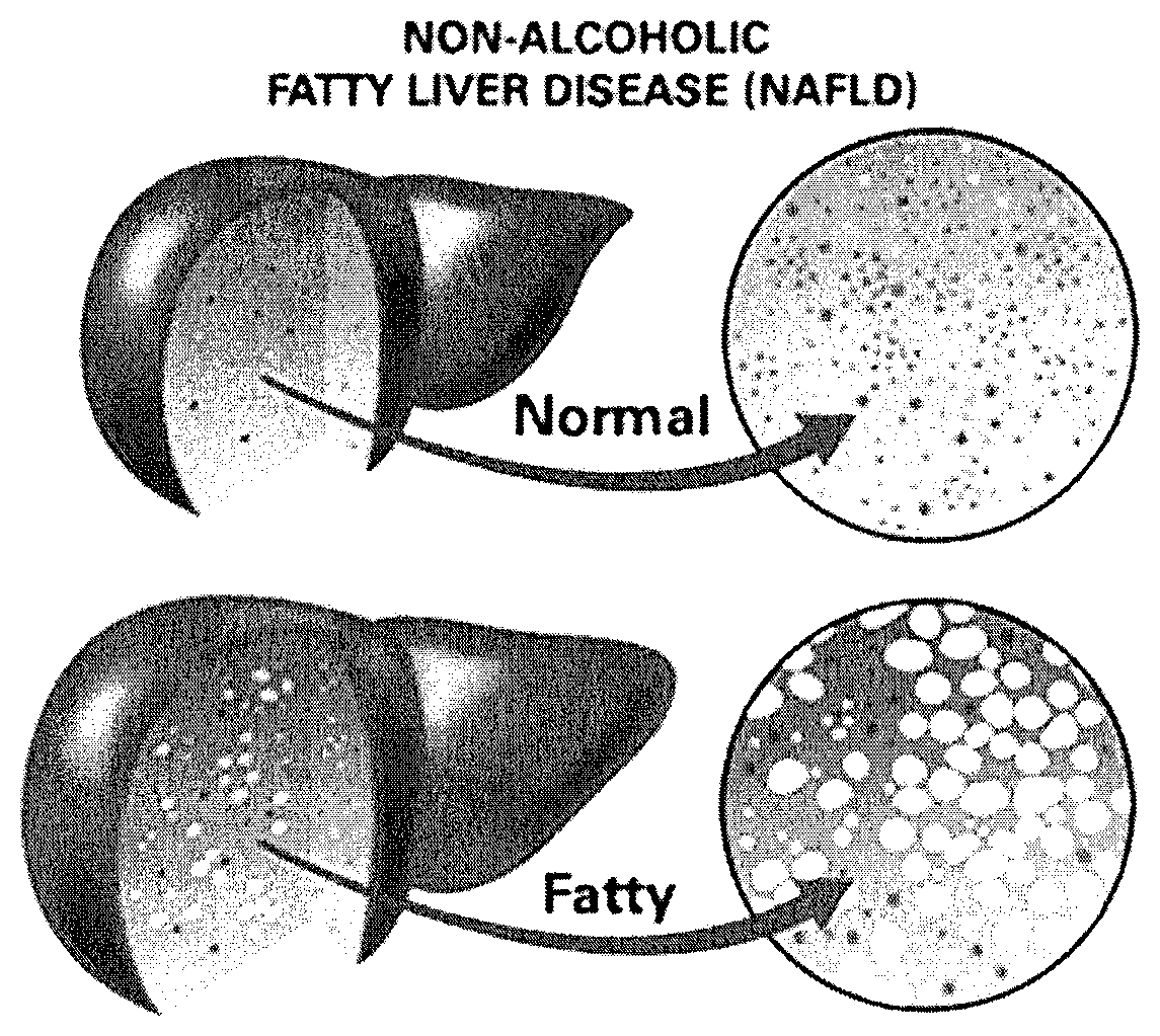 Method and system for reducing the likelihood of developing liver cancer in an individual diagnosed with non-alcoholic fatty liver disease