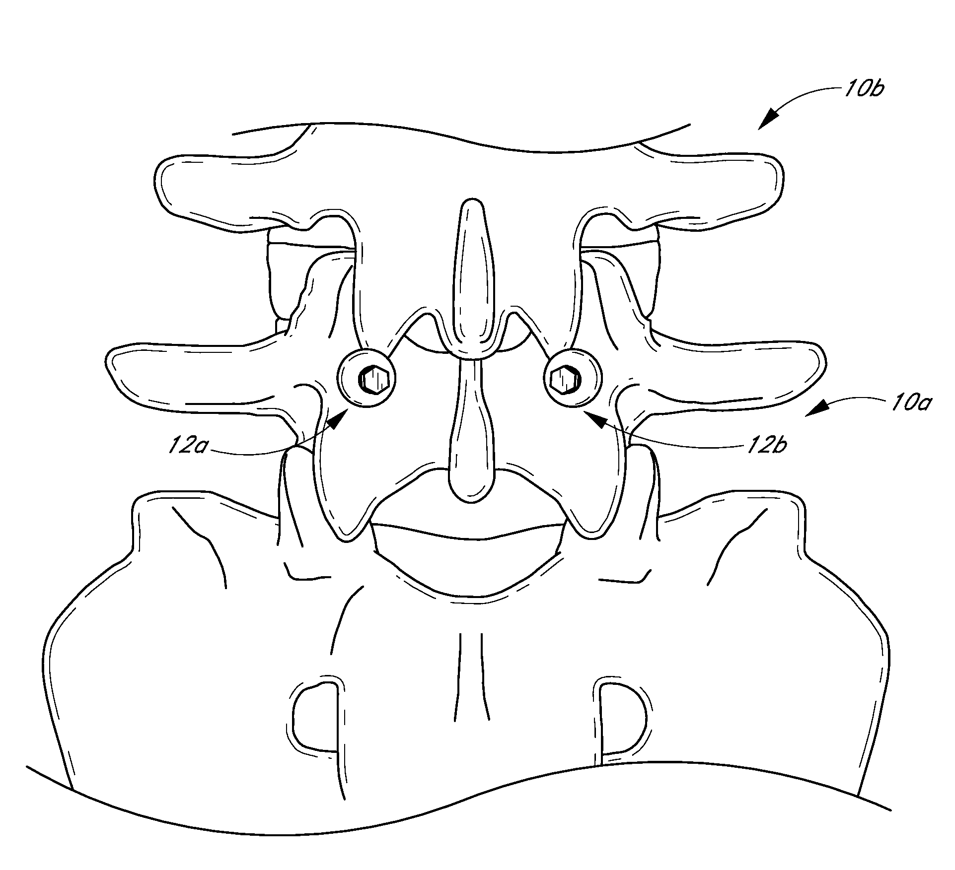 Method and apparatus for spinal stabilization