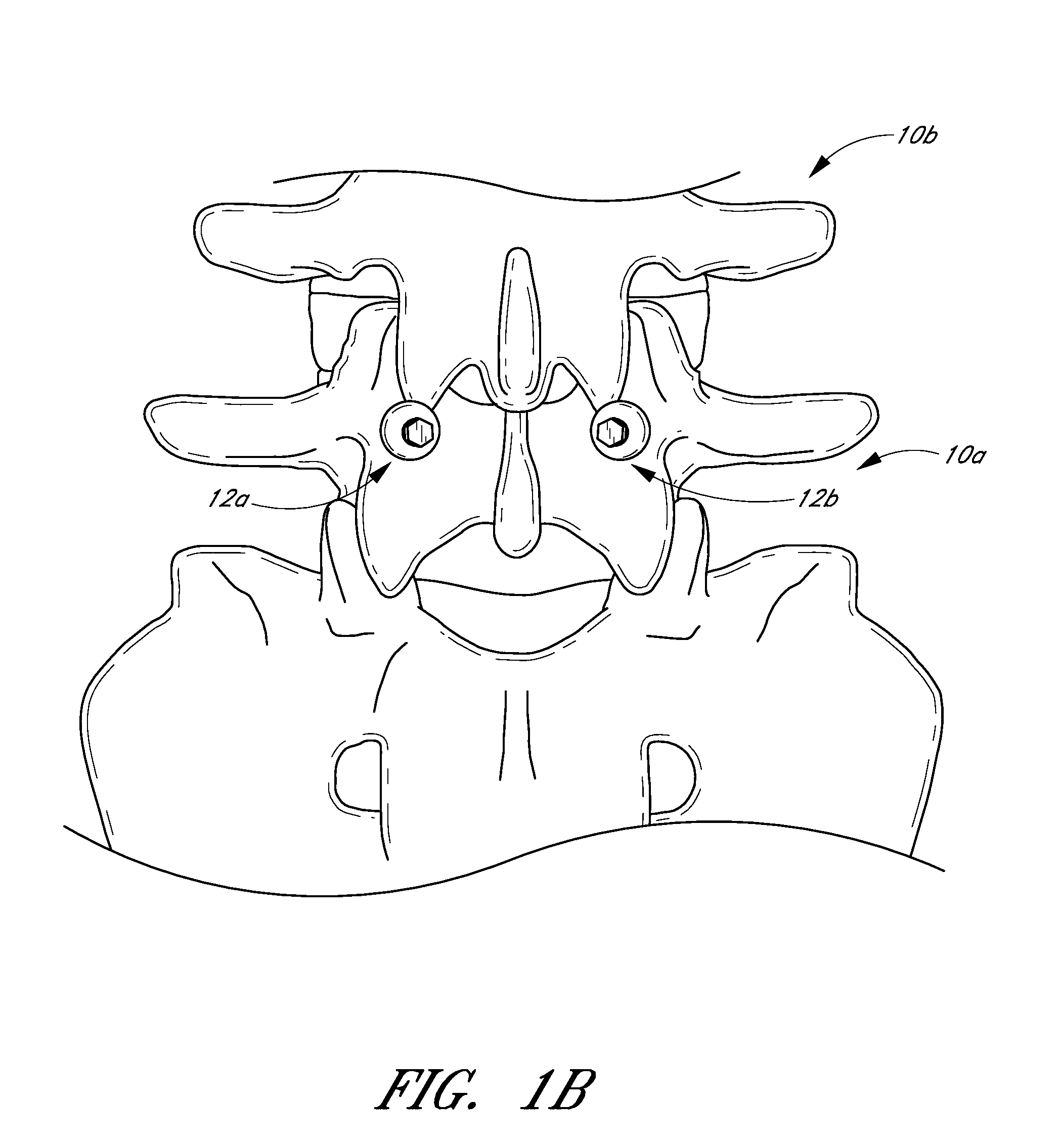 Method and apparatus for spinal stabilization