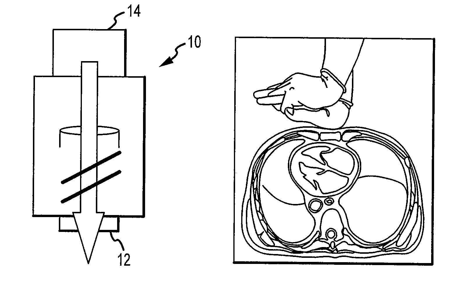 Volume exchanger valve system and method to increase circulation during cpr