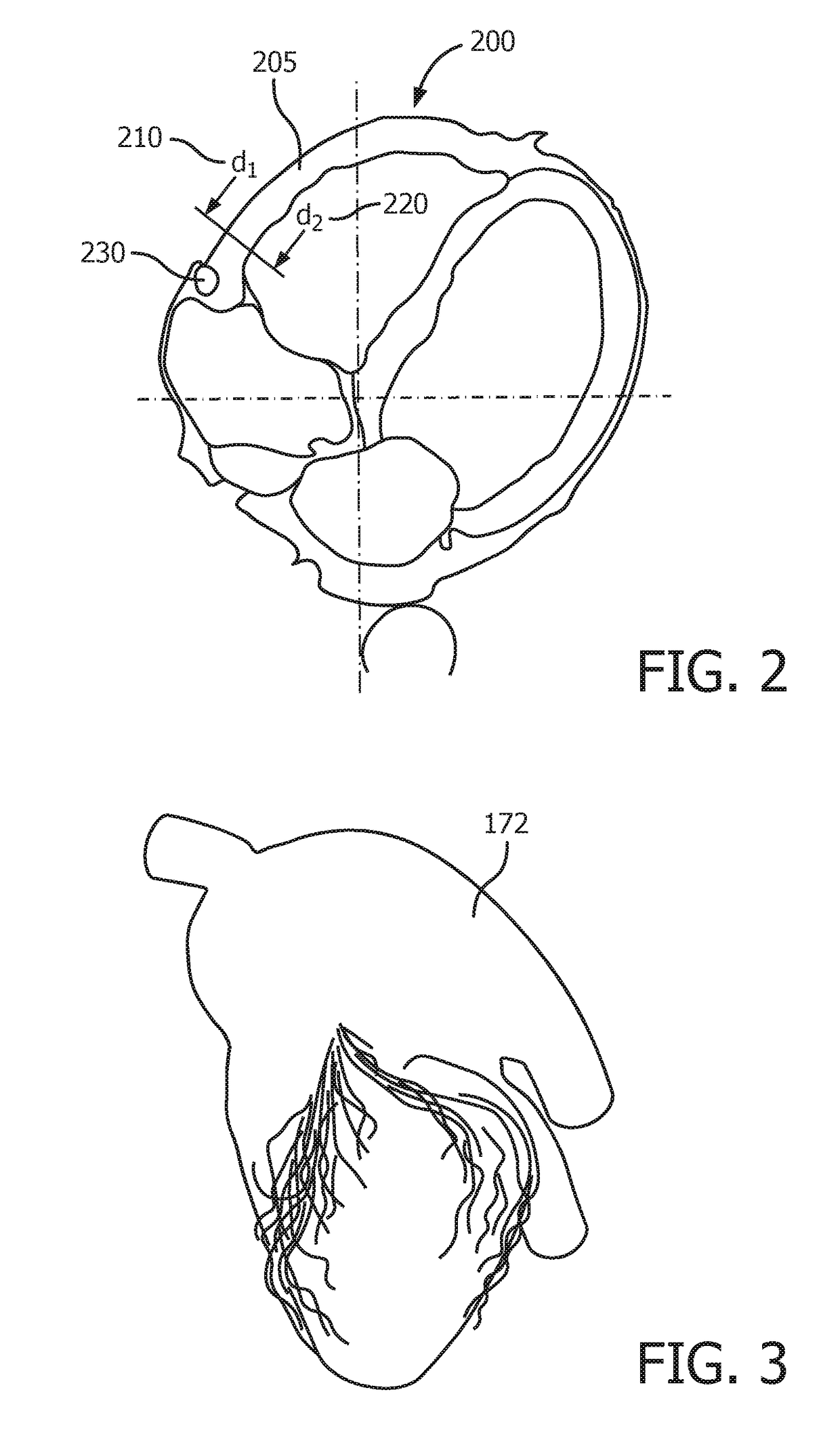 Heart model guided coronary artery segmentation