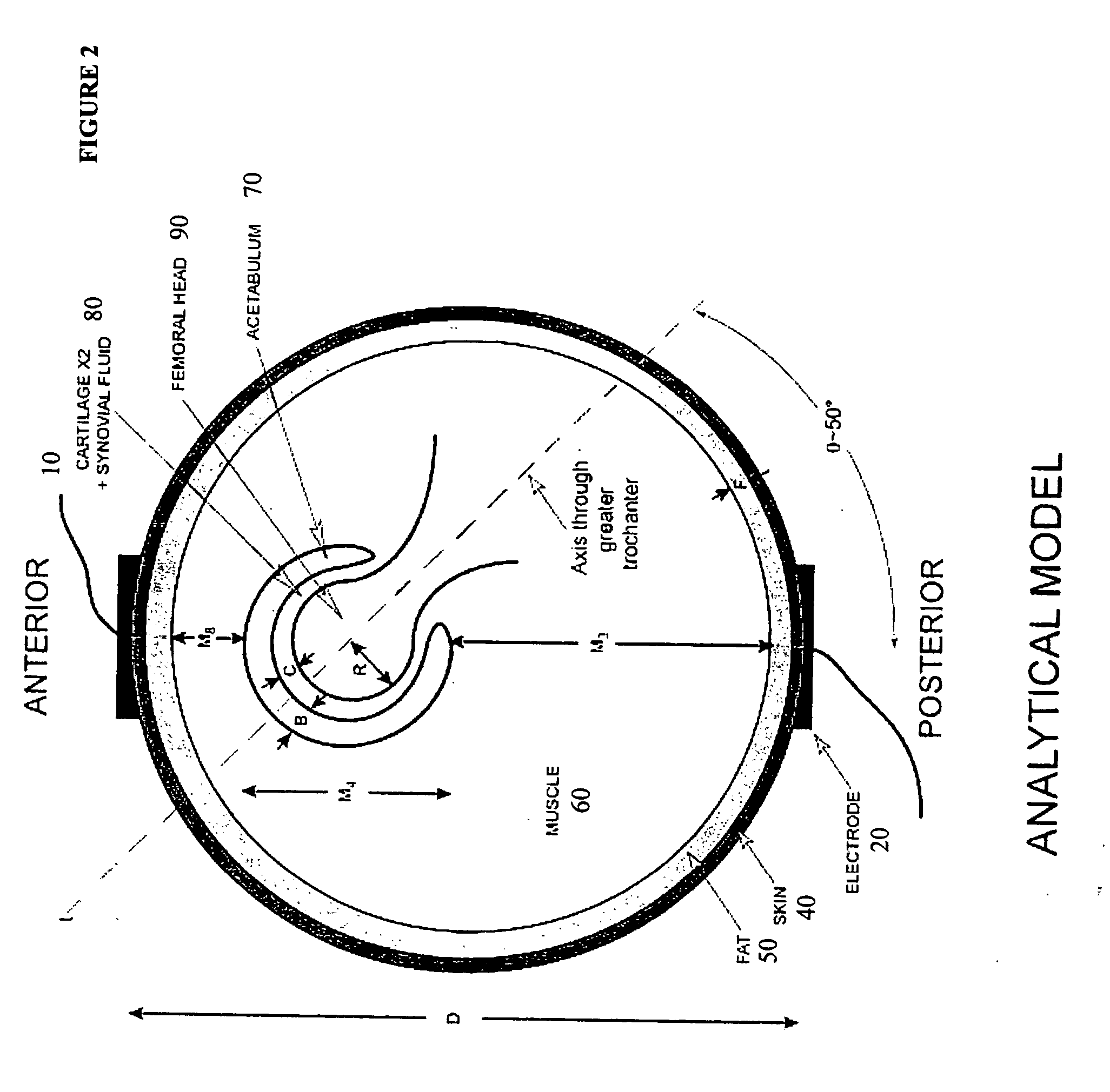 Method and device for treating osteoarthritis and cartilage disease, defects, and injuries in the human hip