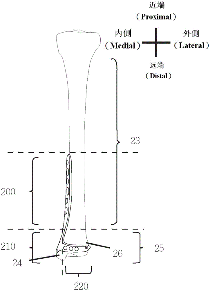 Tibia remote end fixing device