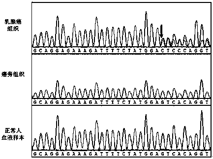 A breast cancer pik3ca mutation gene and its application