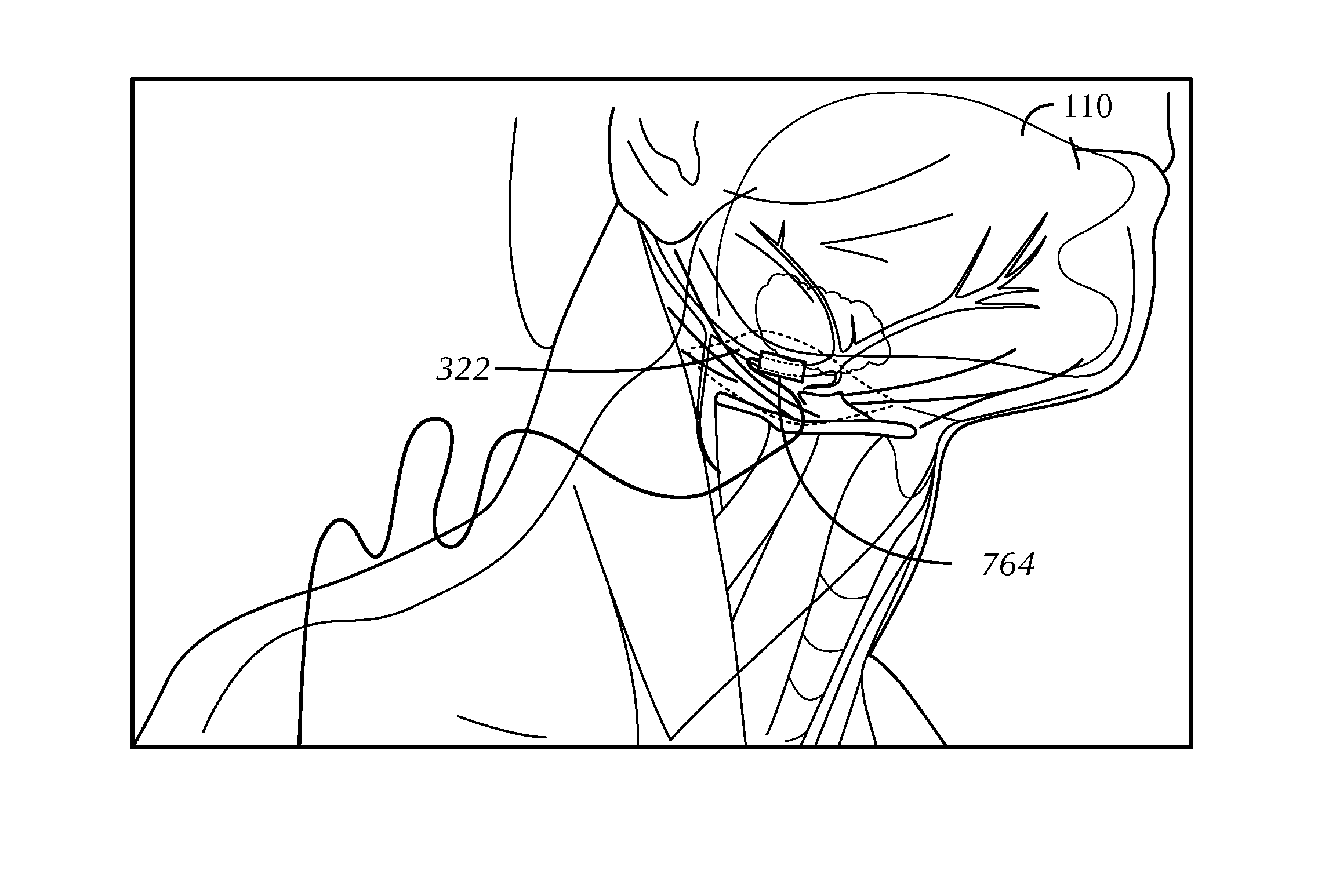 Method for Adjusting a System for Stimulating a Hypoglossal Nerve