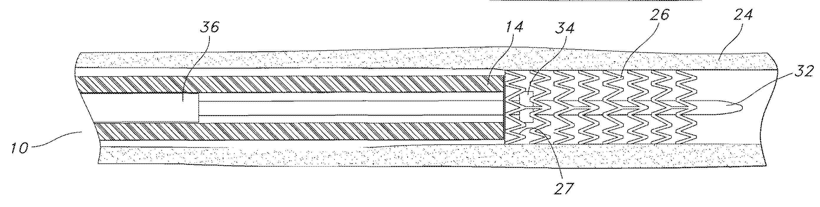 Endoscope with preloaded or preloadable stent