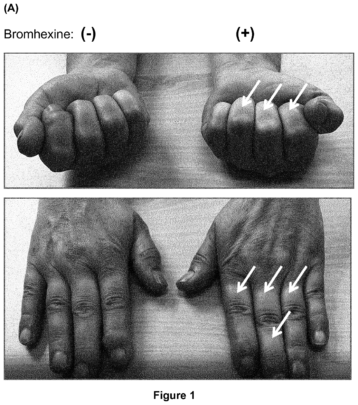 Bromhexine for the treatment of pain