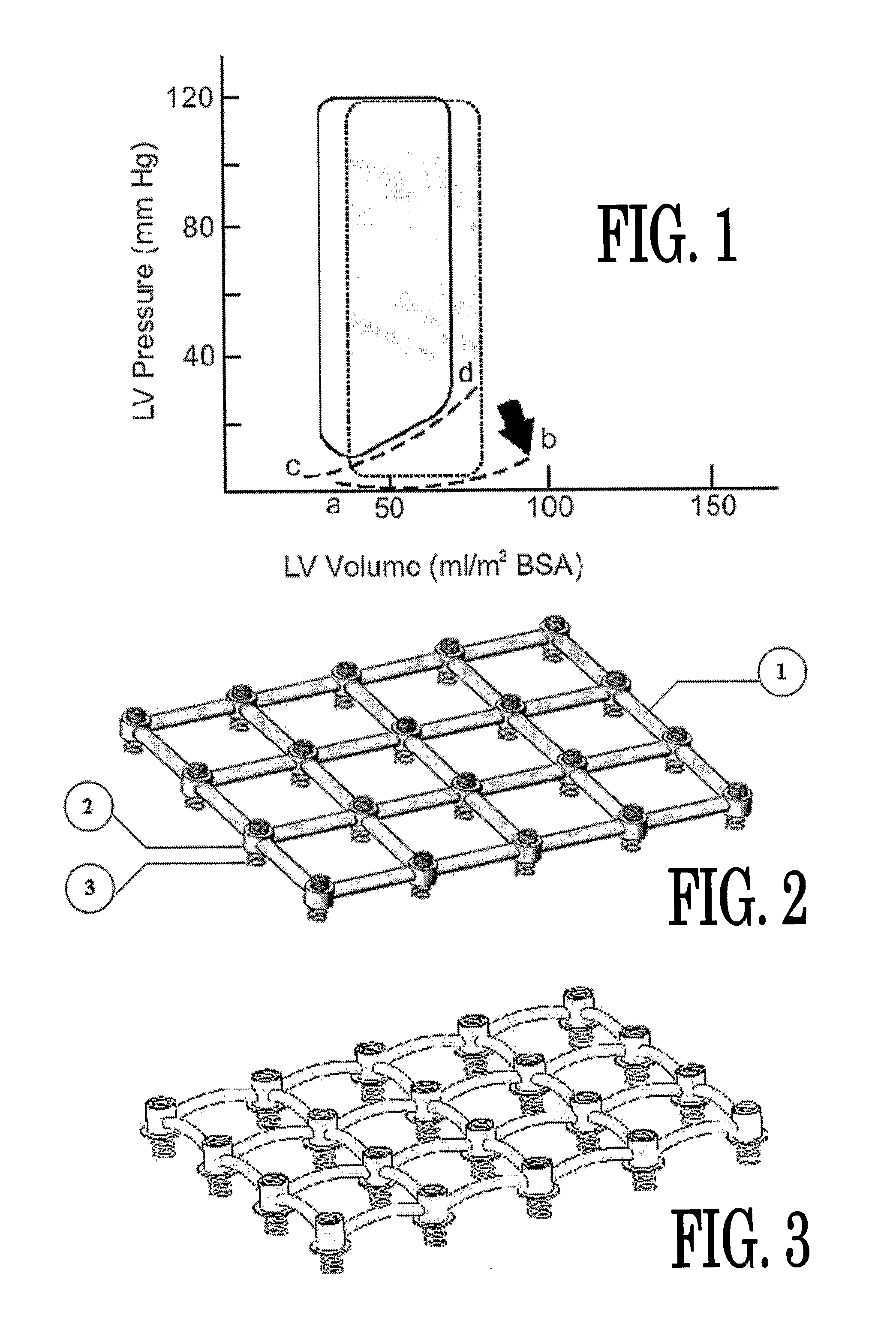 In Vivo Device for Assisting and Improving Diastolic Ventricular Function