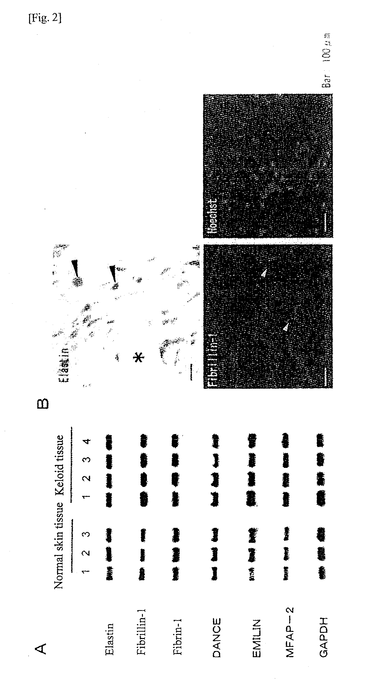 Radical therapeutic agent for keloid and hypertrophic scar