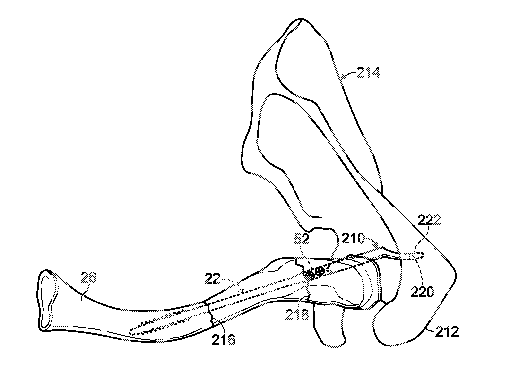 Bone fixation using an intramedullary pin