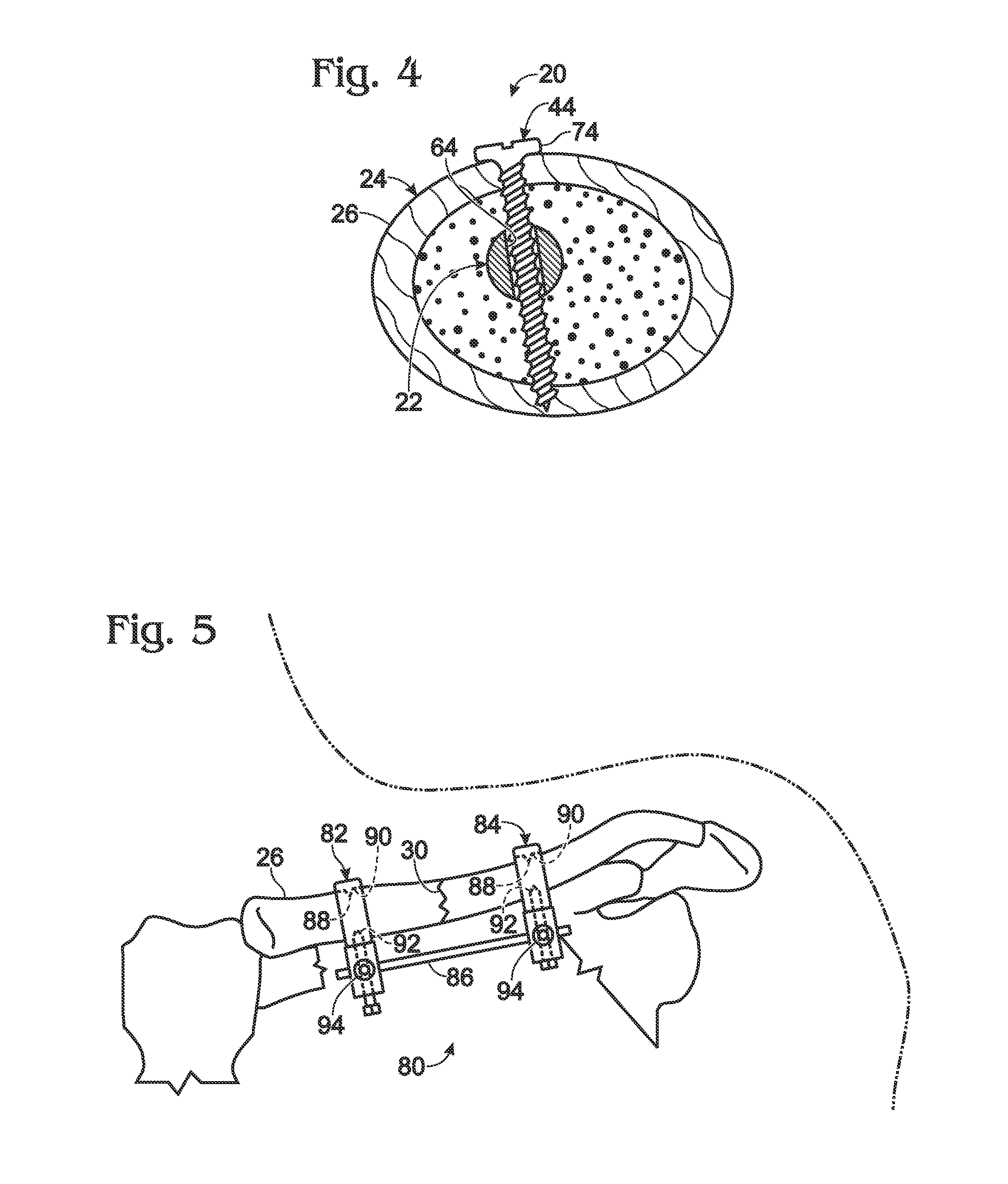 Bone fixation using an intramedullary pin