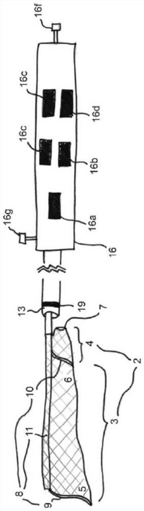 Transcatheter anti embolic filter for arterial and venous vessels