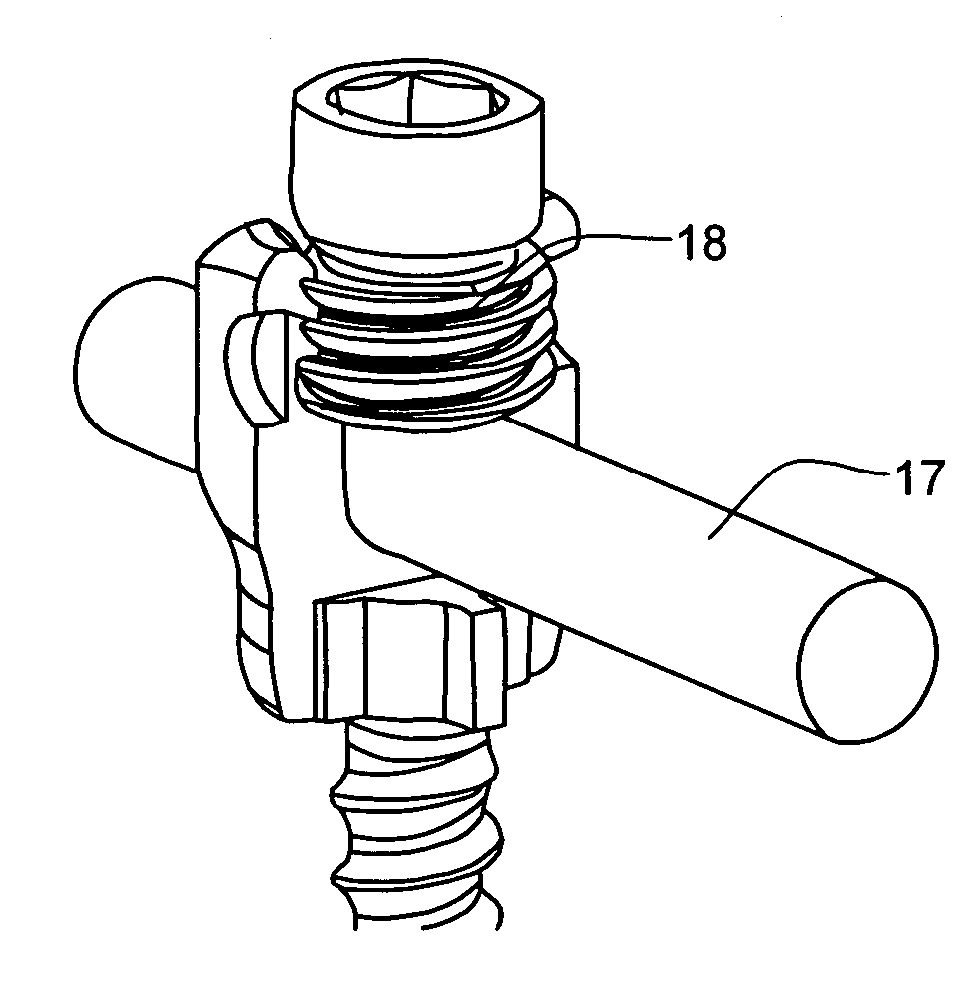 Bone anchor system utilizing a molded coupling member for coupling a bone anchor to a stabilization member and method therefor