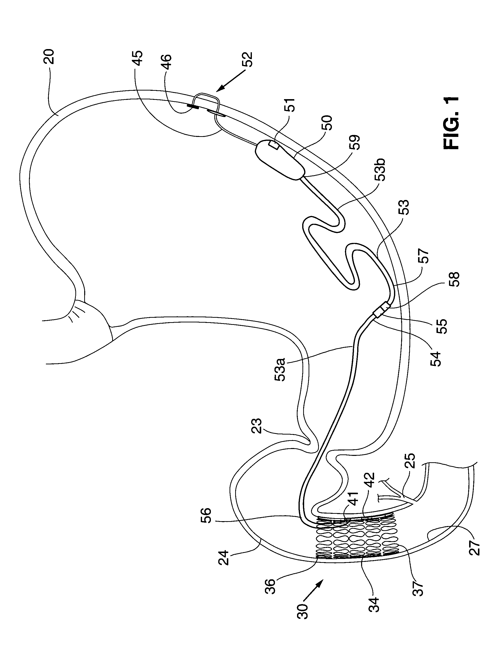 Gastrointestinal stimulation device