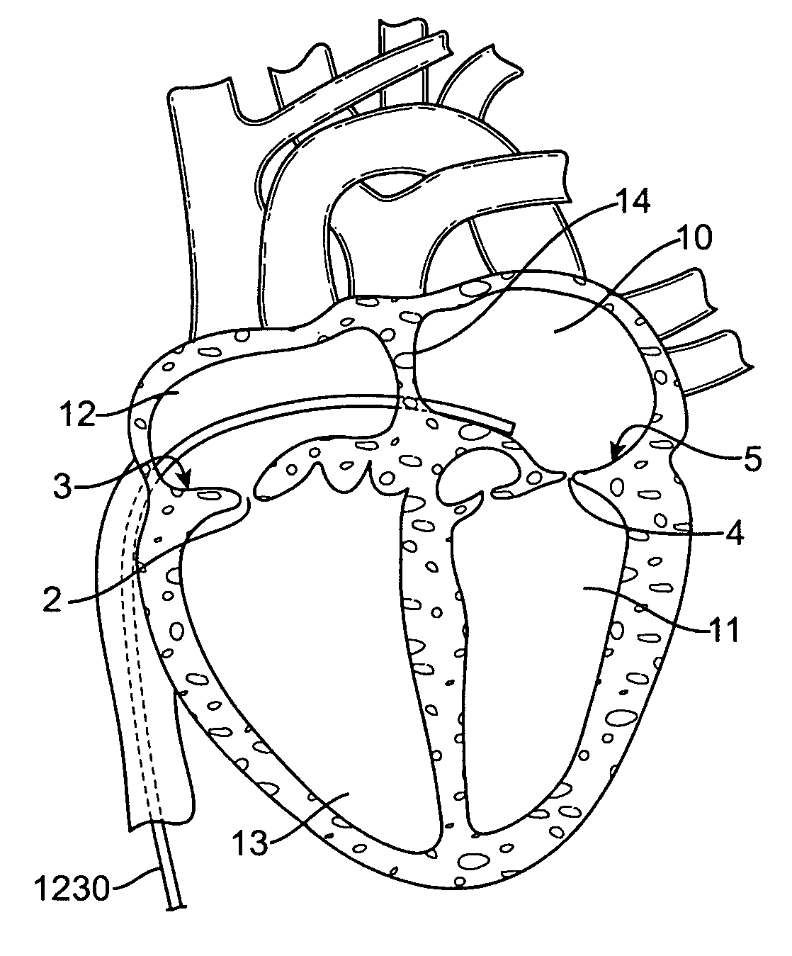 Devices and Methods for Treating Valvular Regurgitation