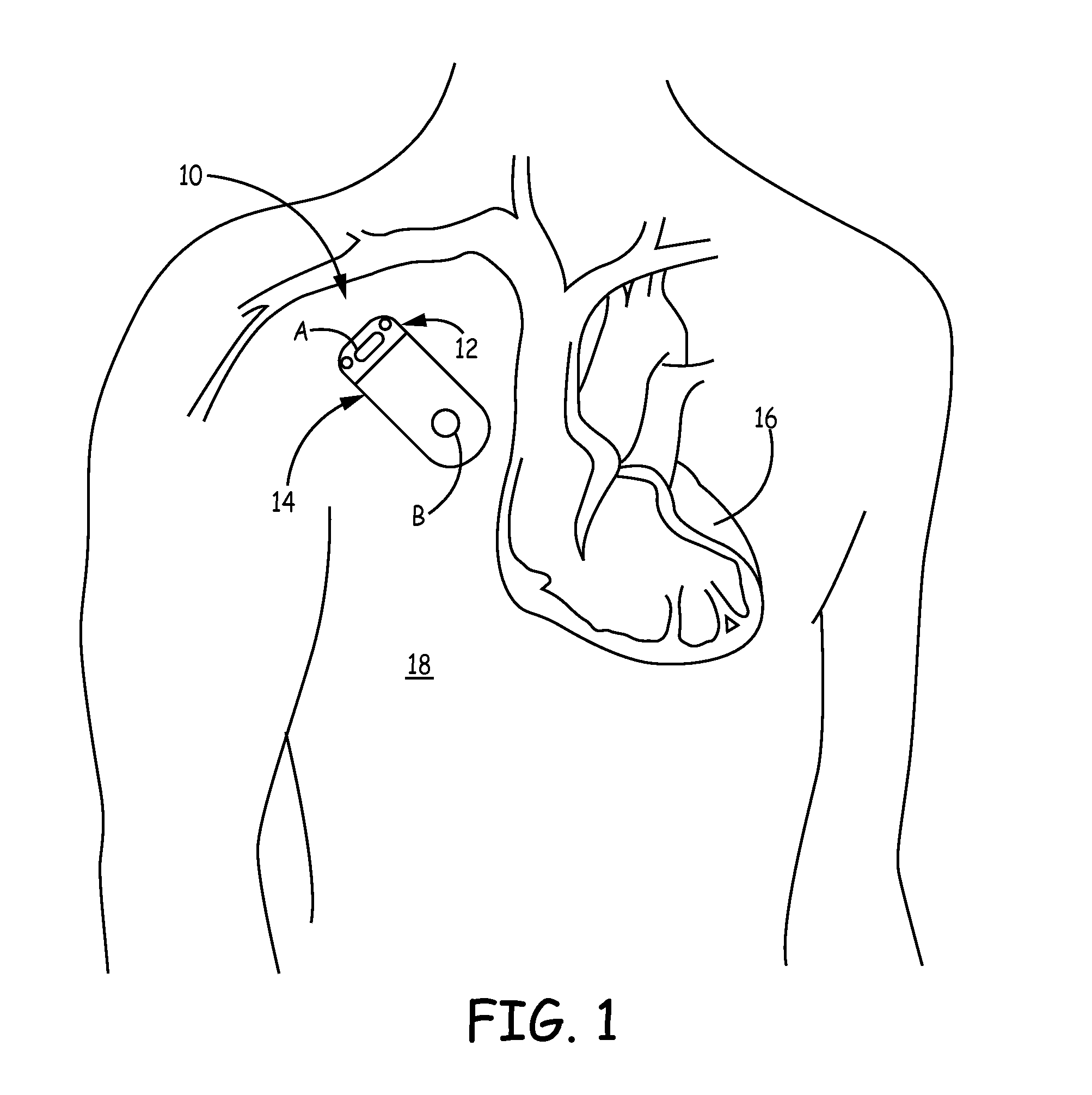 Method and apparatus for automatic configuration of implantable medical devices