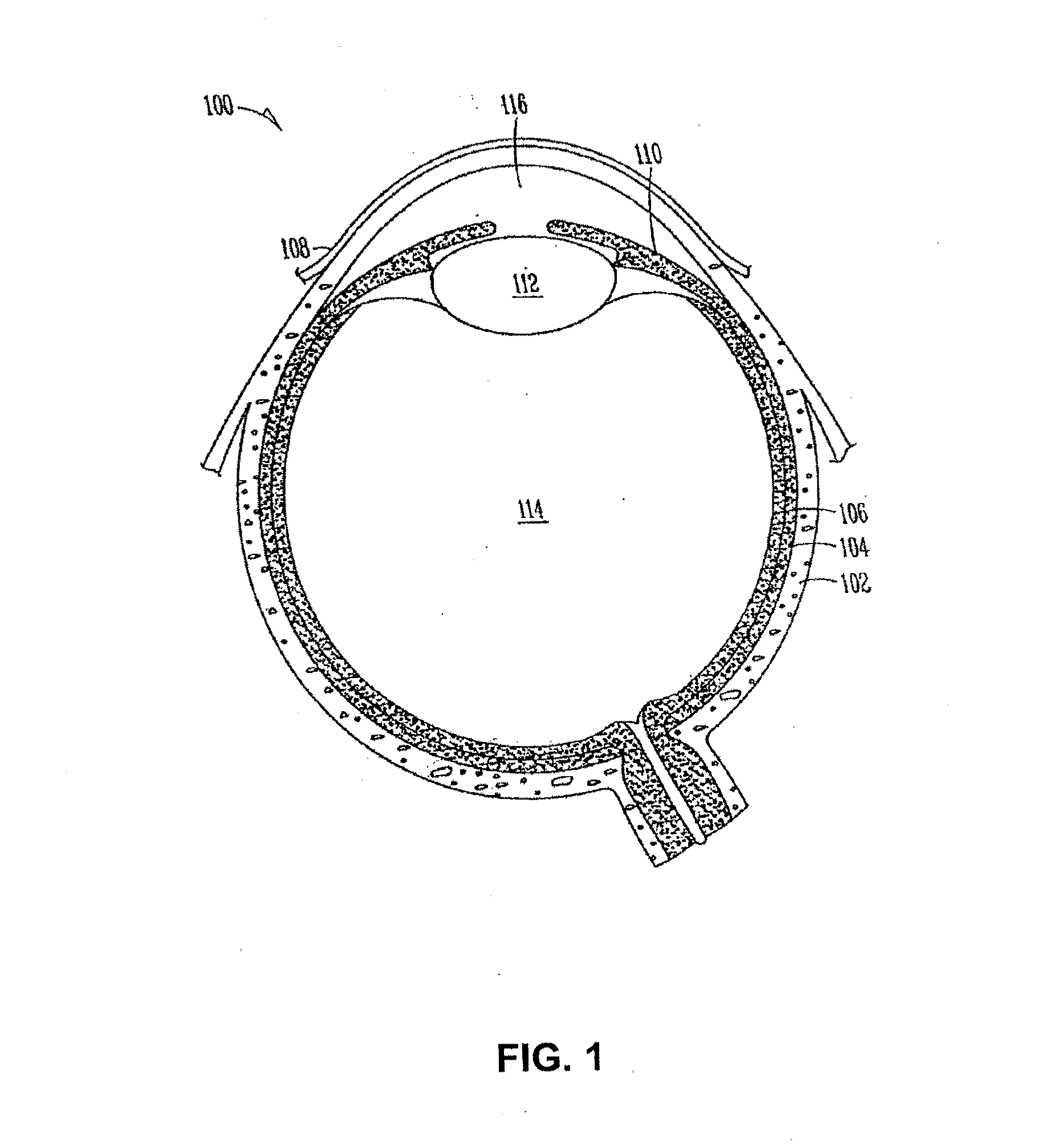 Drug delivery system and methods of treating open angle glaucoma and ocular hypertension