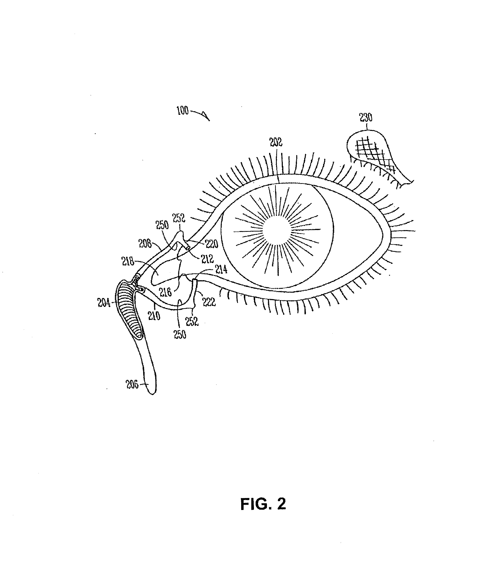 Drug delivery system and methods of treating open angle glaucoma and ocular hypertension