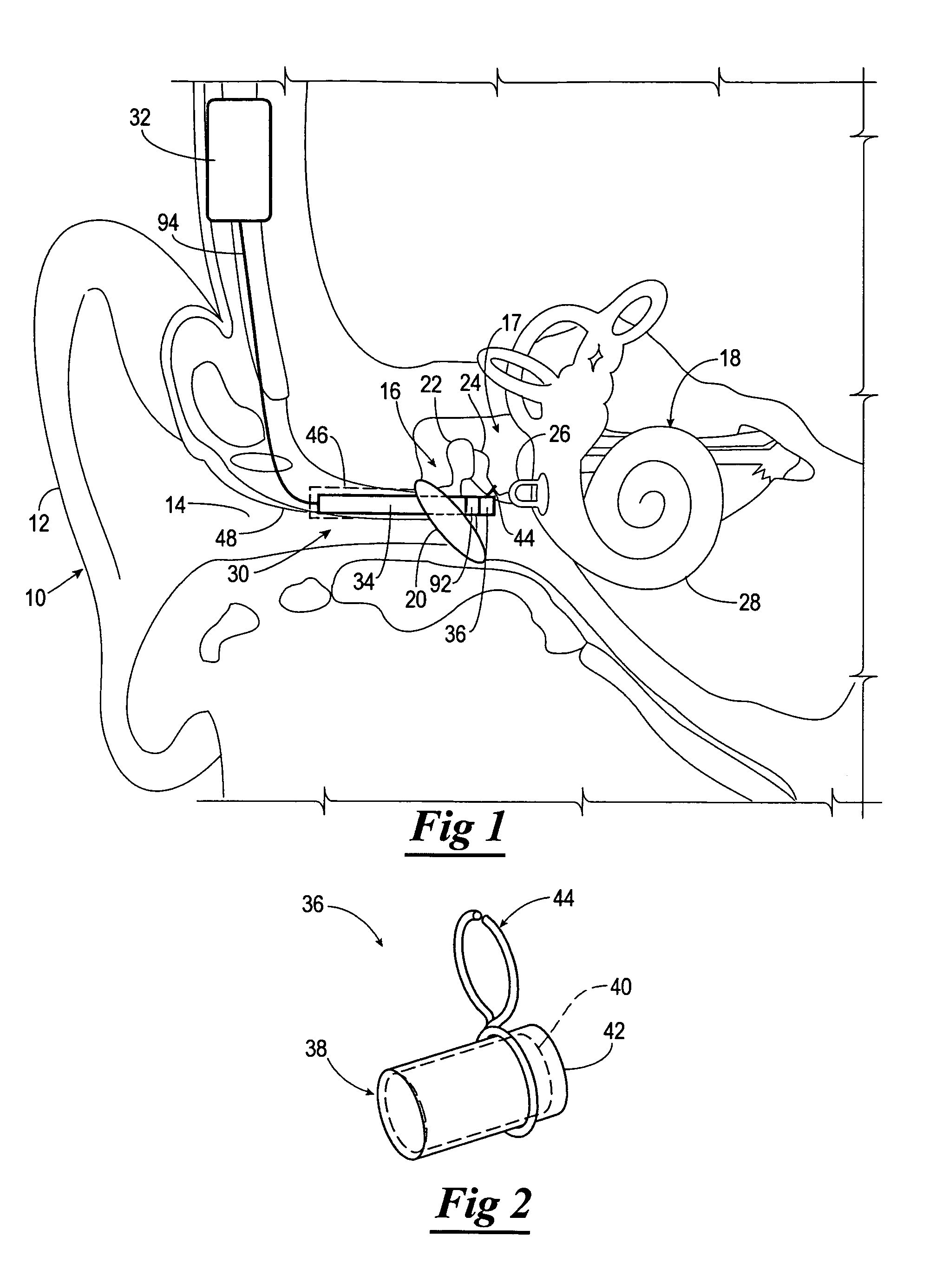 Totally implantable hearing system