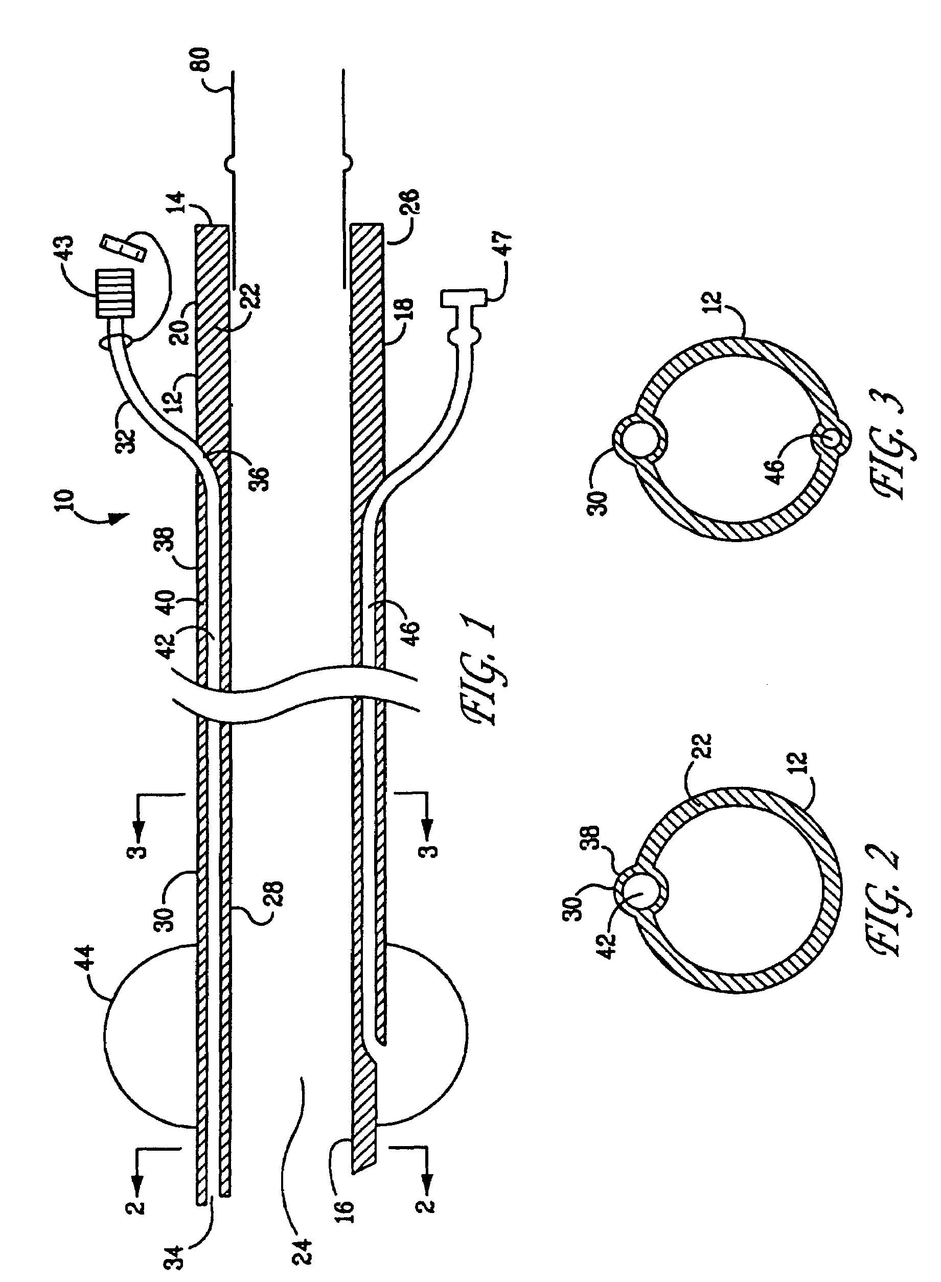 Jet endotracheal device and its use in intubation