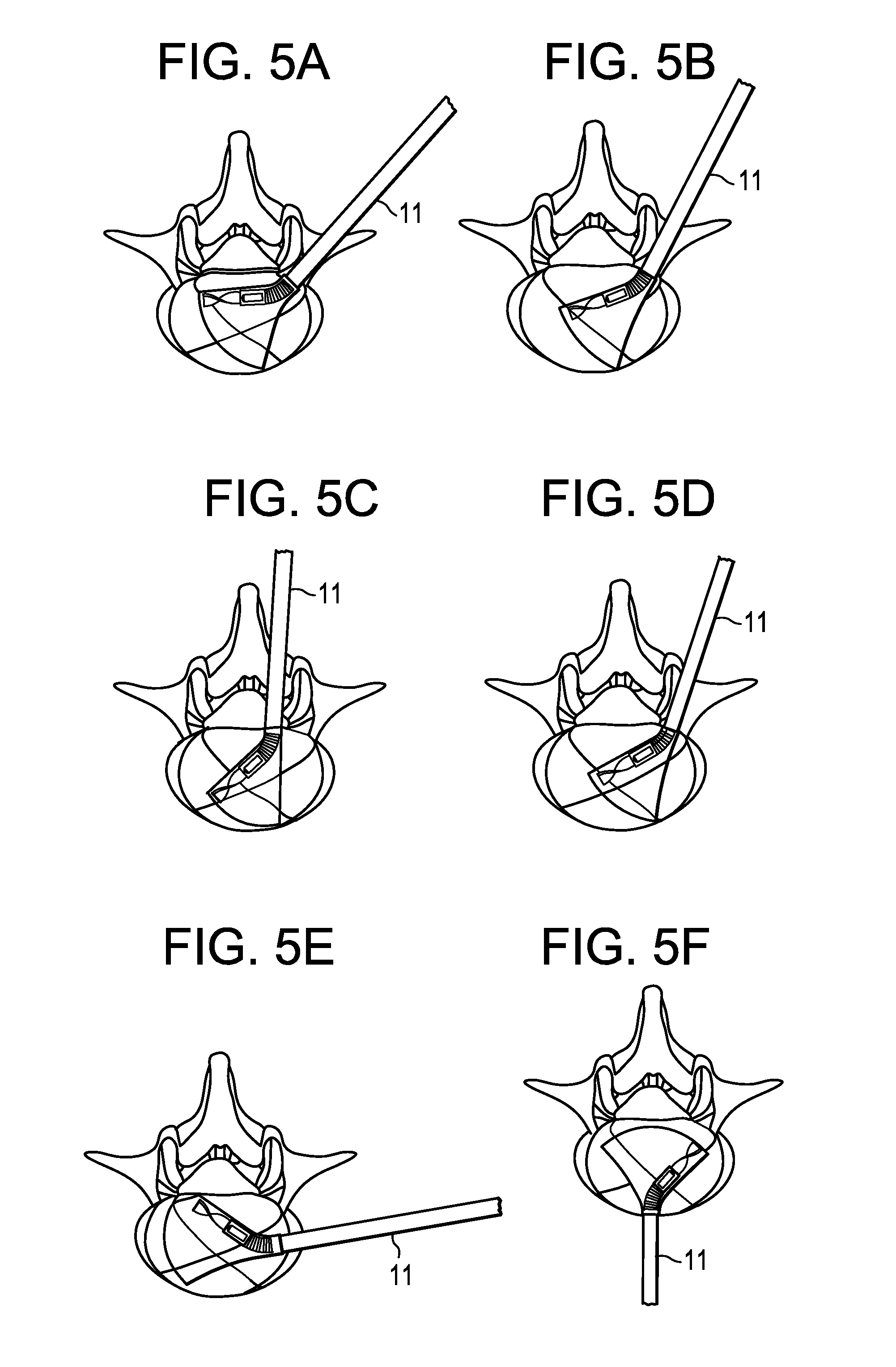 Percutaneous Disc Clearing Device