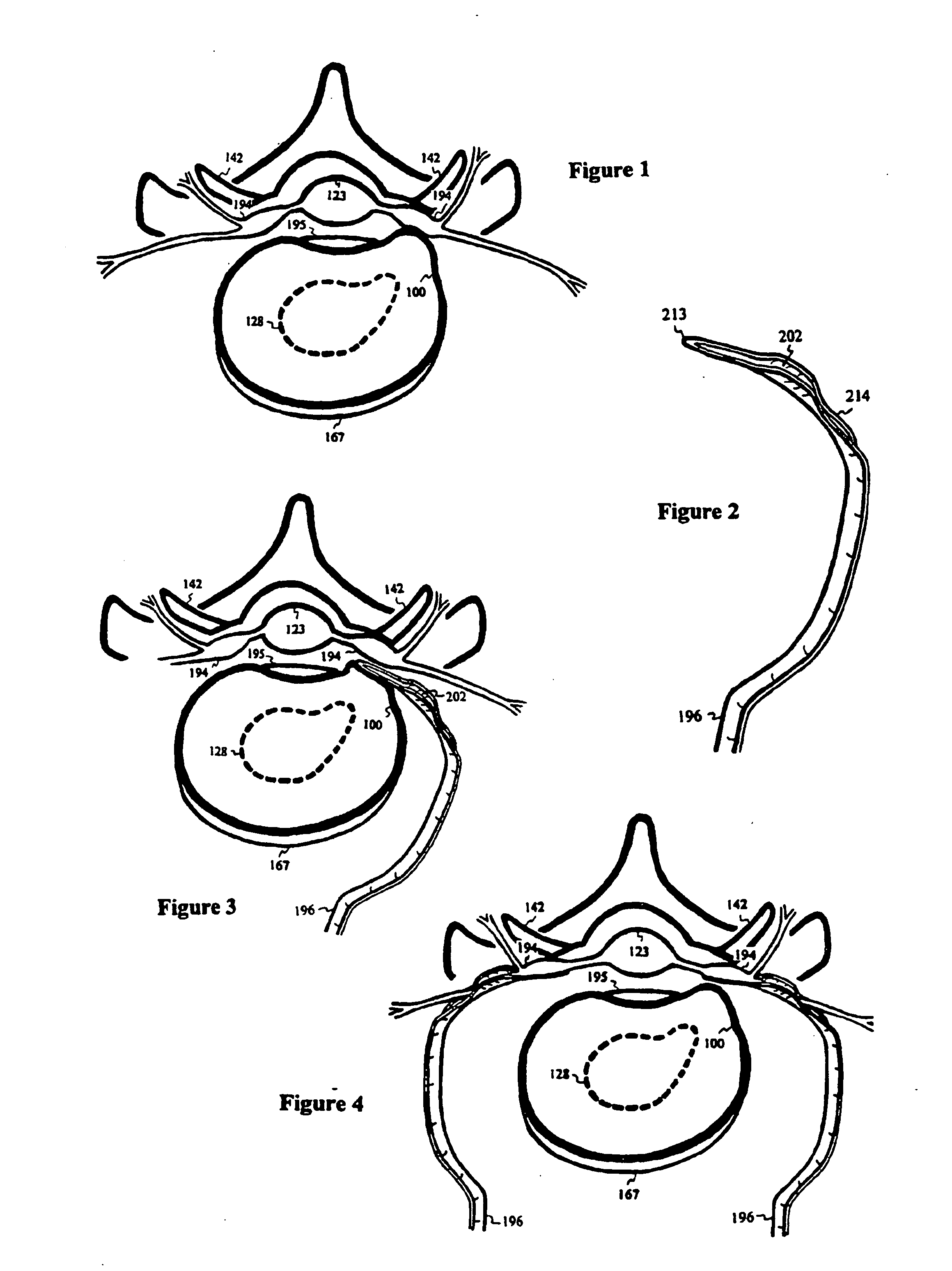 Intervertebral disc inserting device