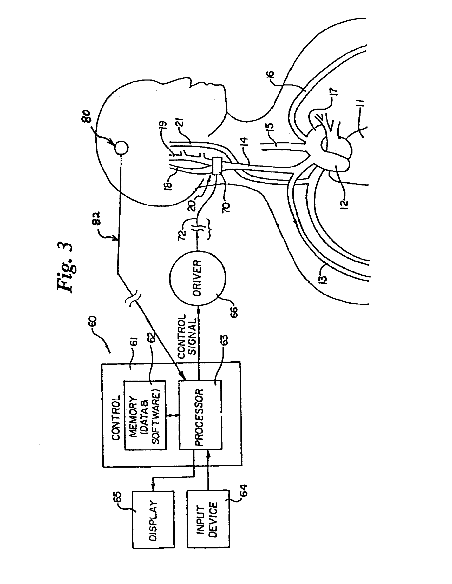 Baroreflex activation for pain control, sedation and sleep