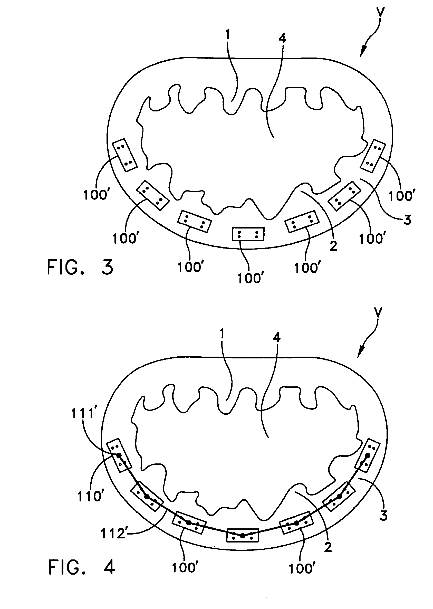 Automated annular plication for mitral valve repair