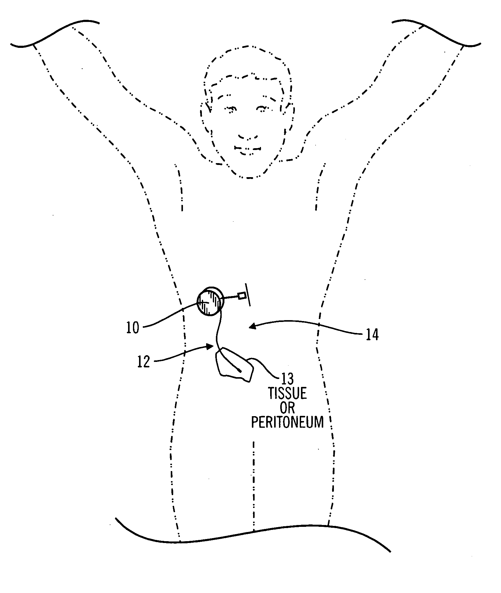 Method and system for non-vascular sensor implantation