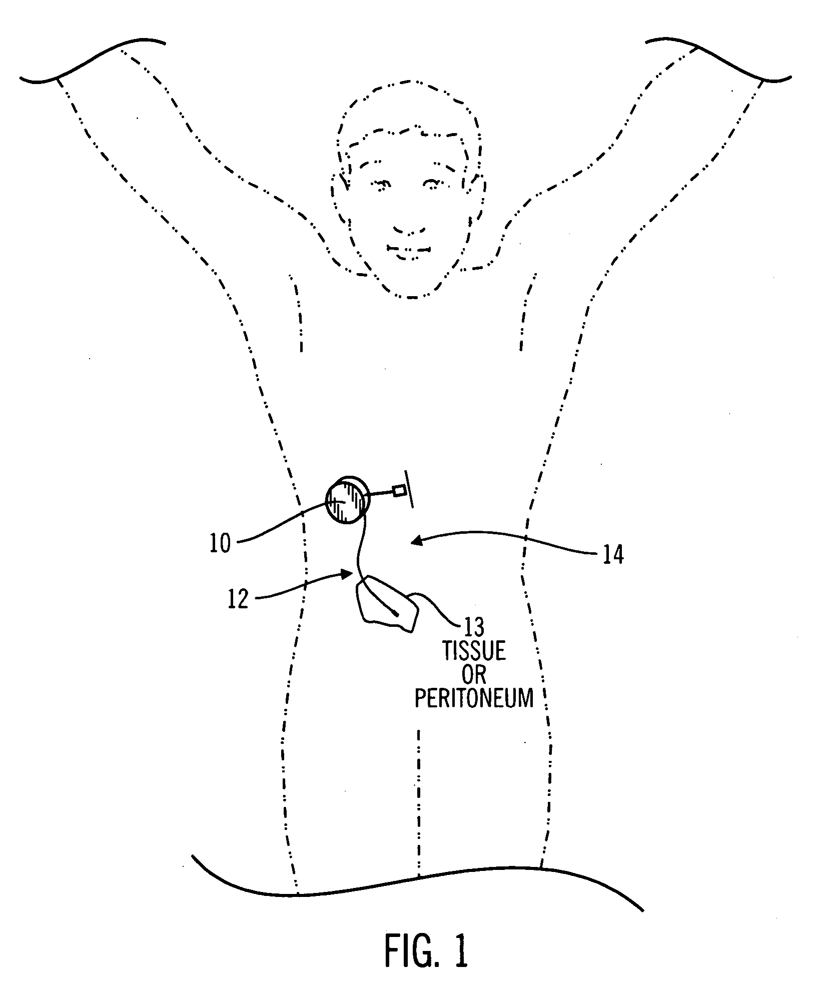 Method and system for non-vascular sensor implantation