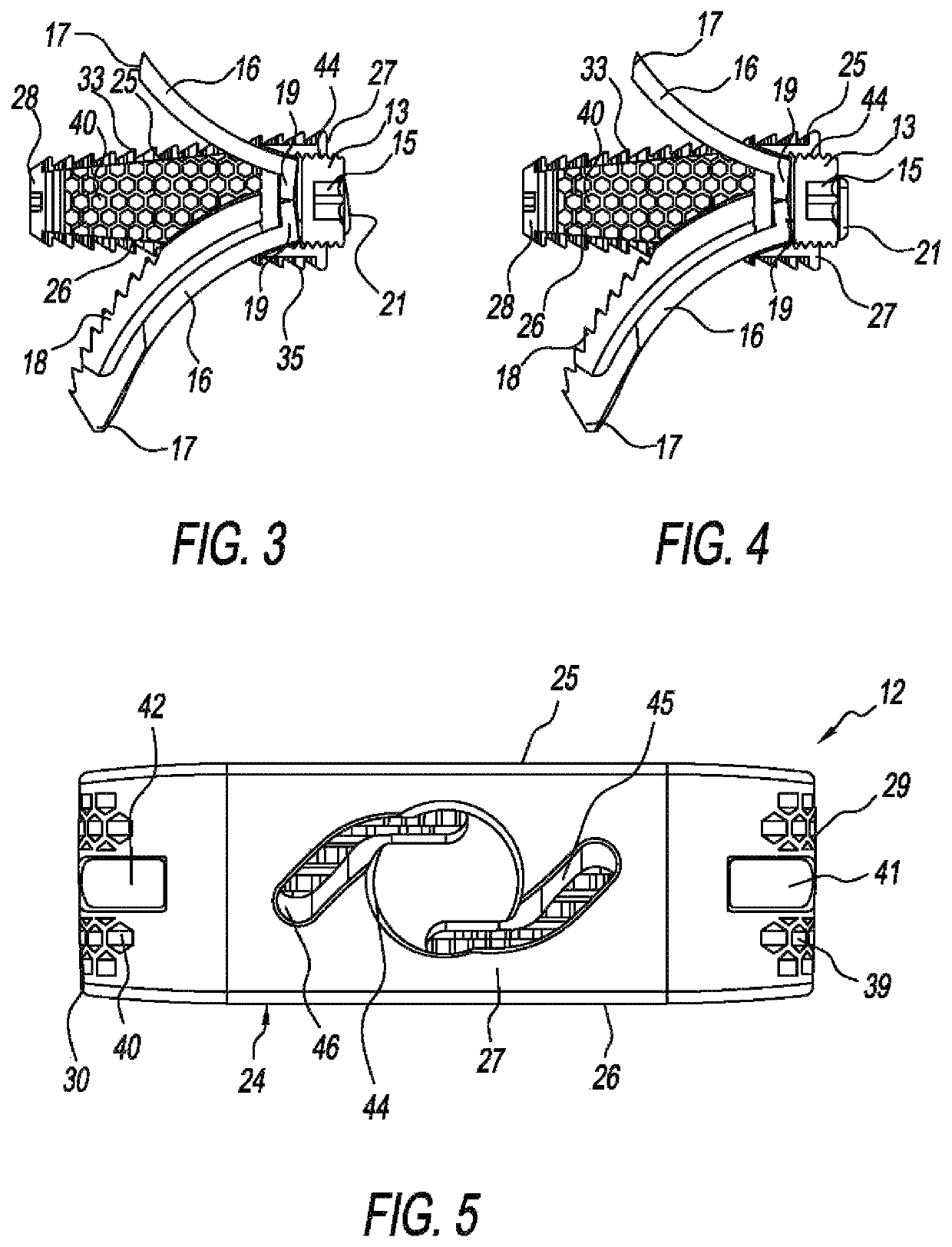 Stand-alone ALIF spine implants