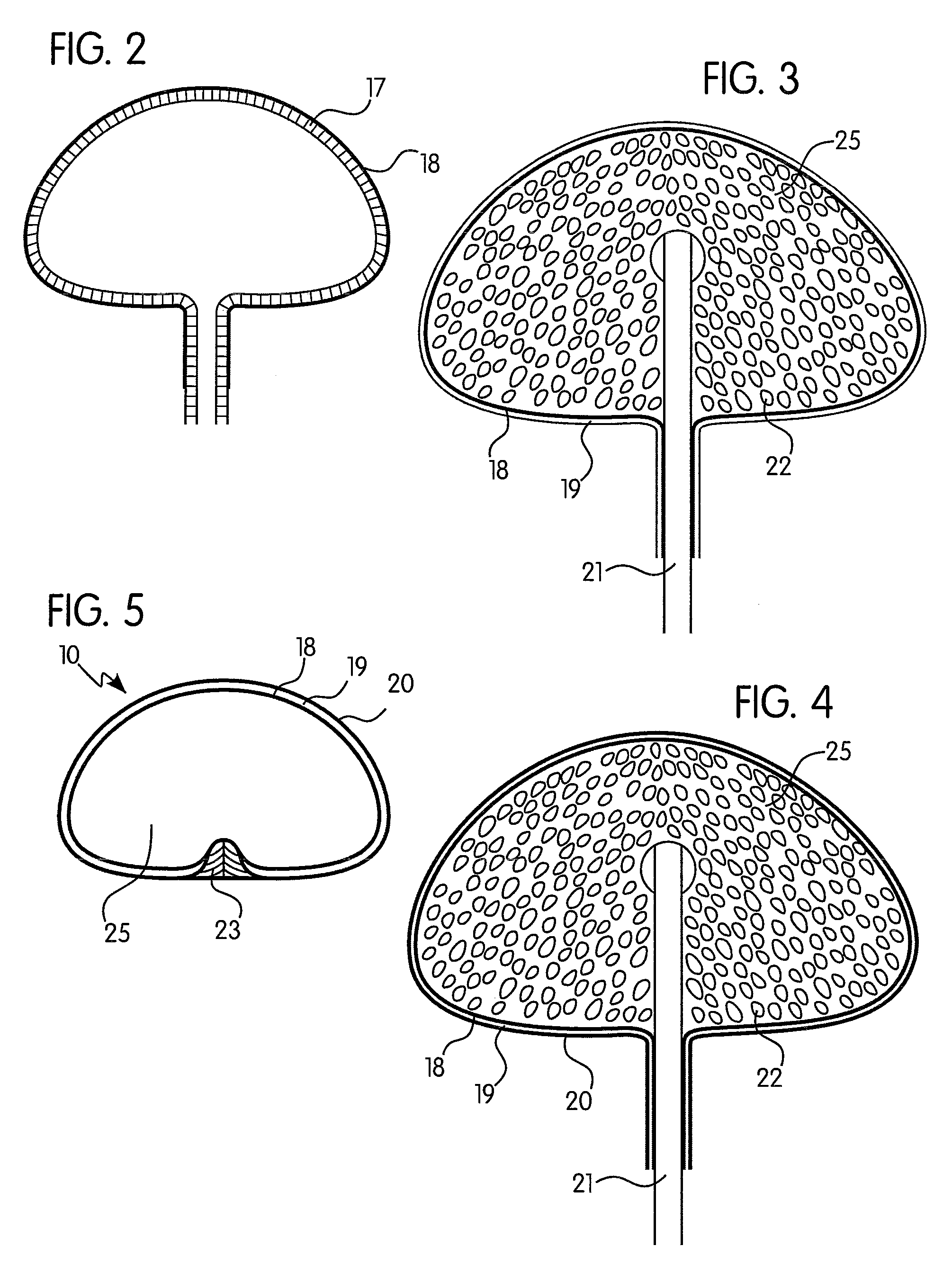 Adjustable implant with self-sealing elastomeric membrane and methods of fabrication thereof