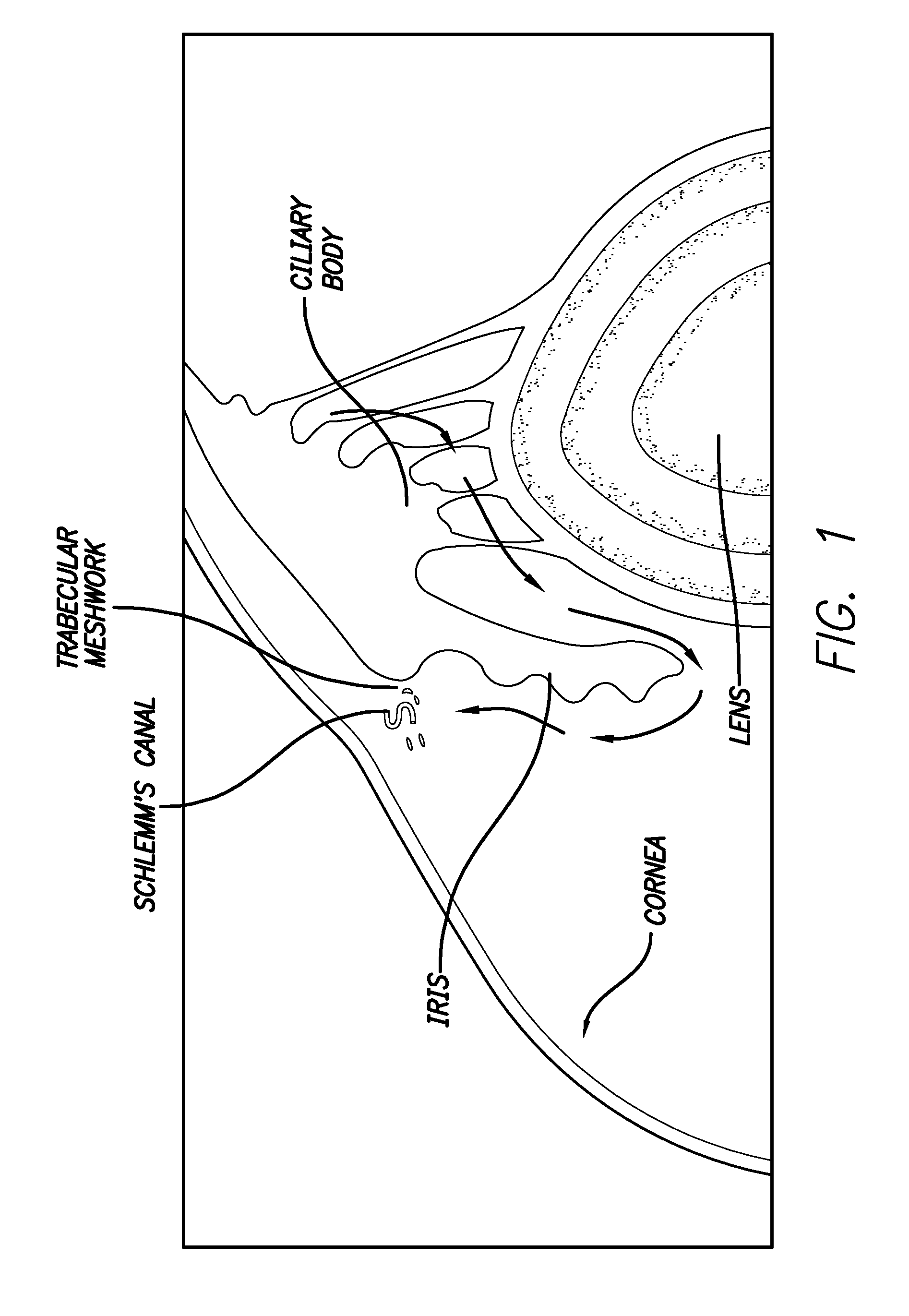 Ultrasonic treatment of glaucoma