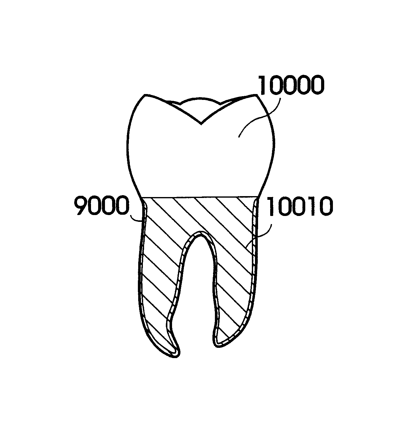 Customized dental prosthesis for periodontal- or osseointegration, and related systems and methods