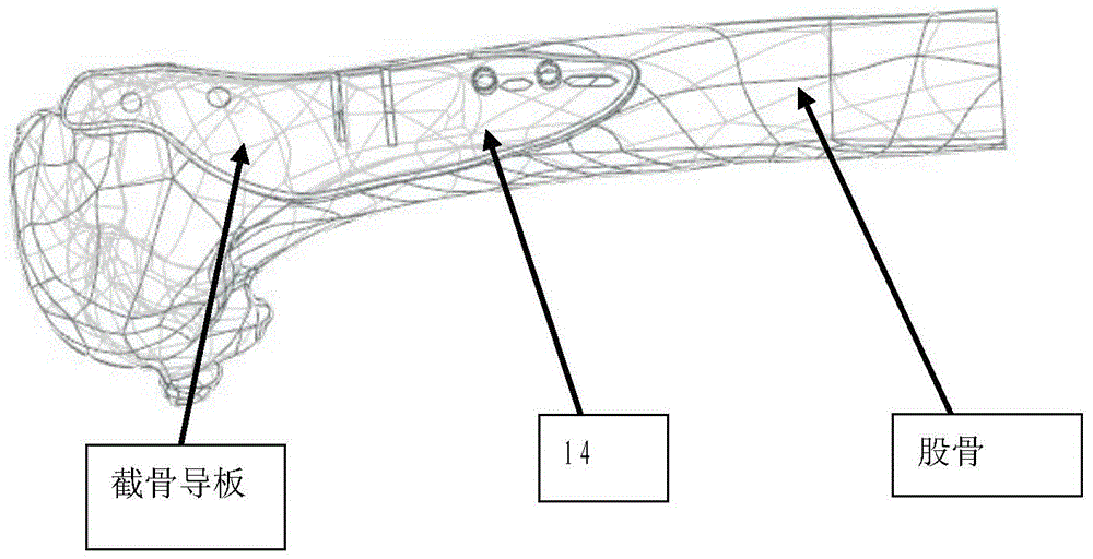 An individualized customized osteotomy orthopedic guide plate and manufacturing method thereof