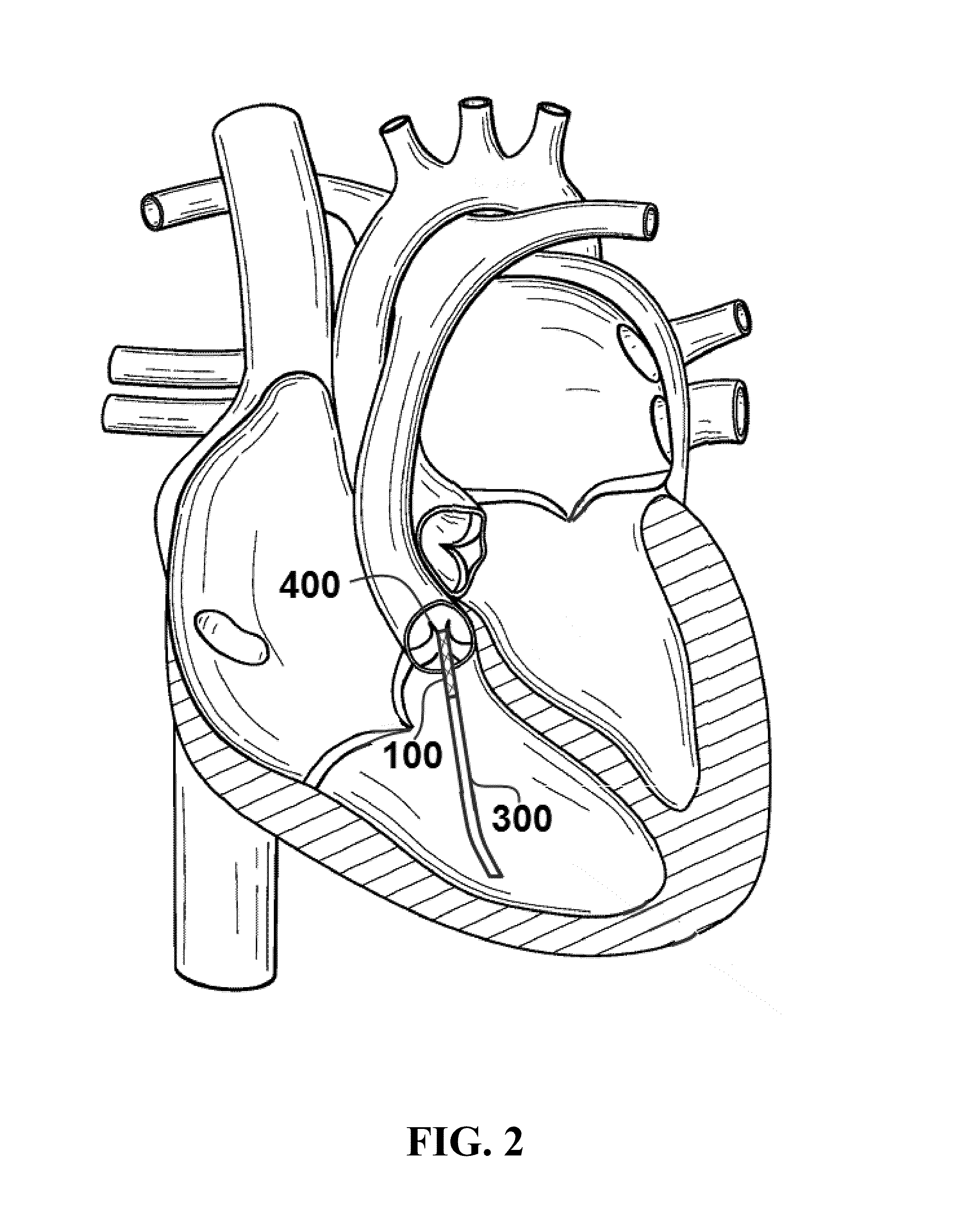 Systems and methods utilizing expandable transcatheter valve