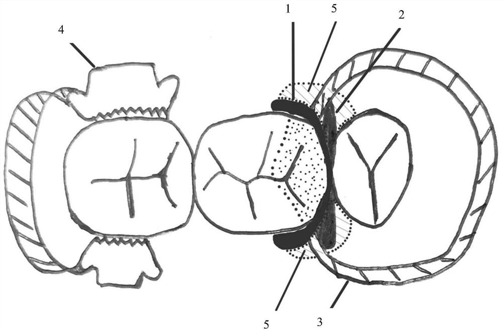 A personalized proximal surface forming system and its preparation and method for assisting filling of affected teeth