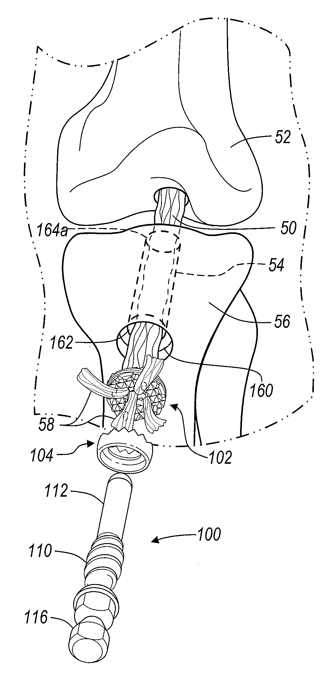 Device and method of fastening a graft to a bone