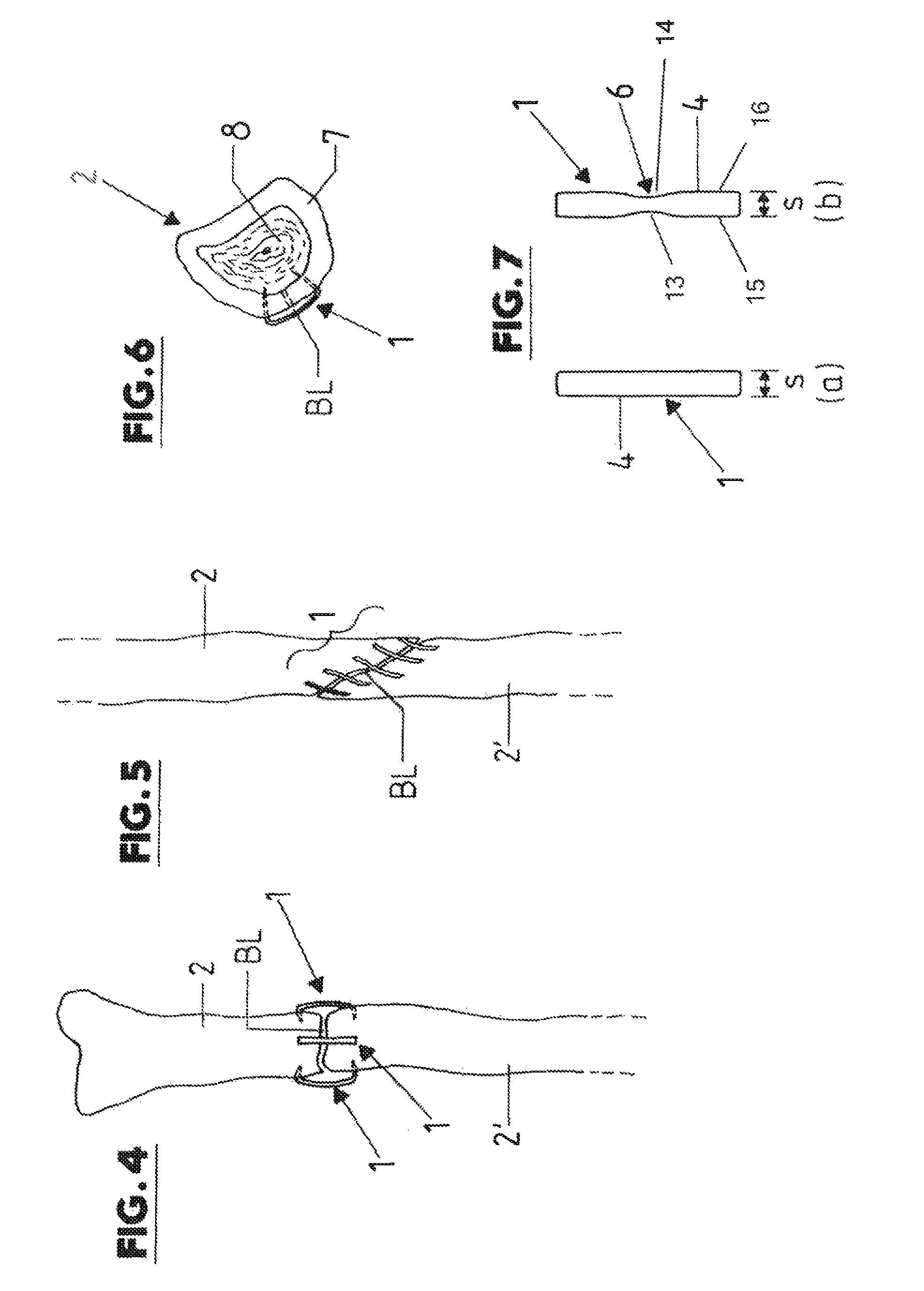 Clip-like implant for osteosynthesis