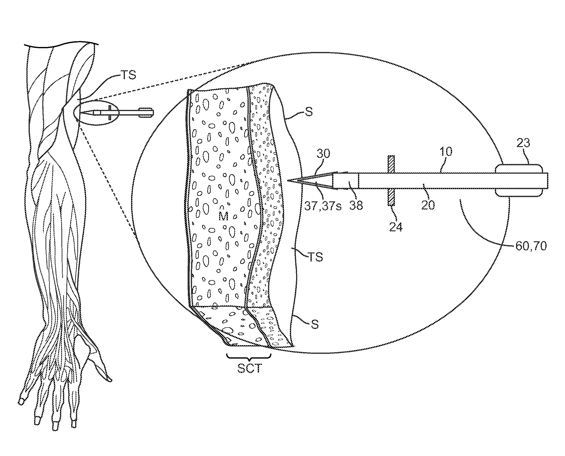 Skin penetrating device and method for subcutaneous solid drug delivery