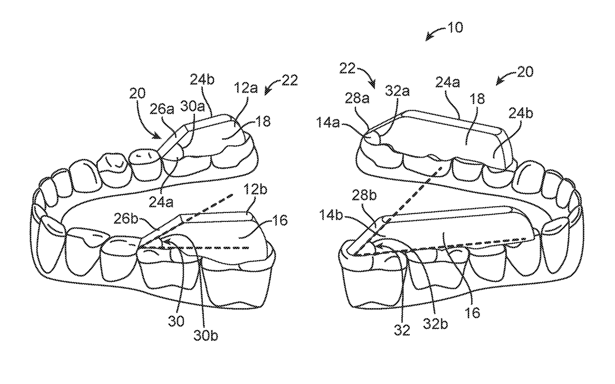 Combined orthodontic movement of teeth with temporomandibular joint therapy