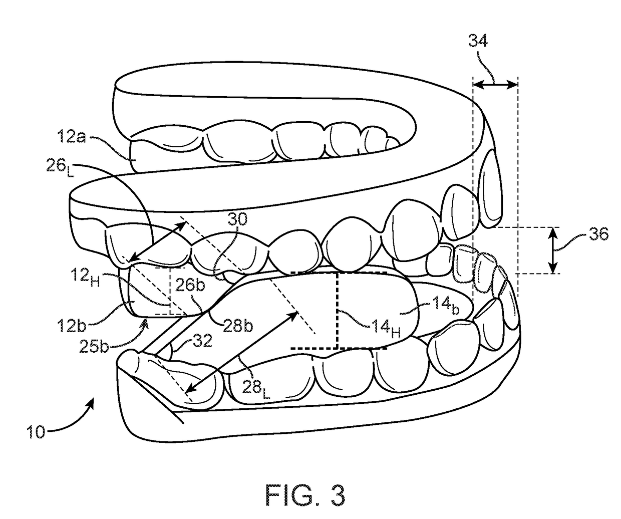 Combined orthodontic movement of teeth with temporomandibular joint therapy