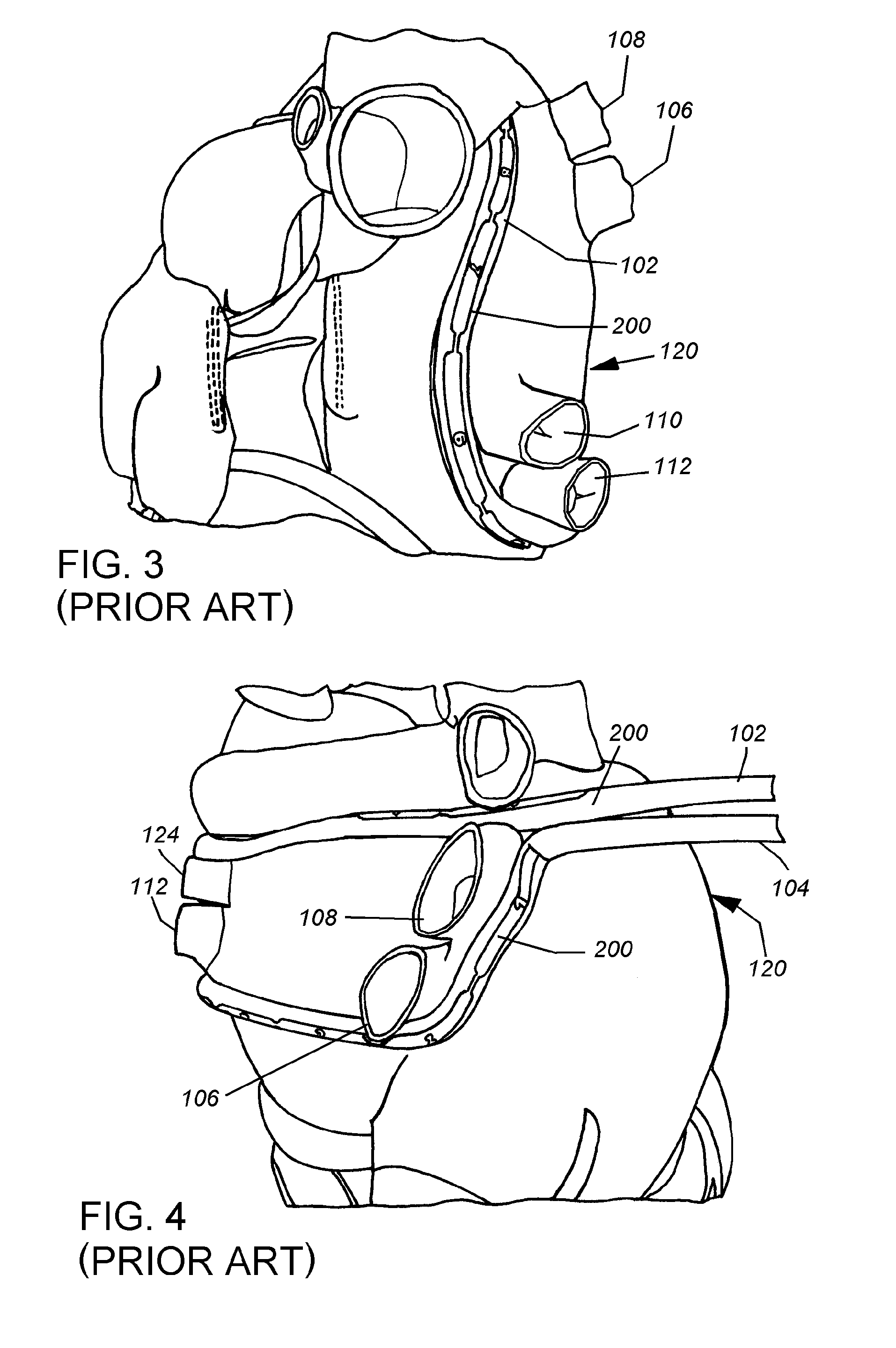 System and method for advancing, orienting, and immobilizing on internal body tissue a catheter or other therapeutic device