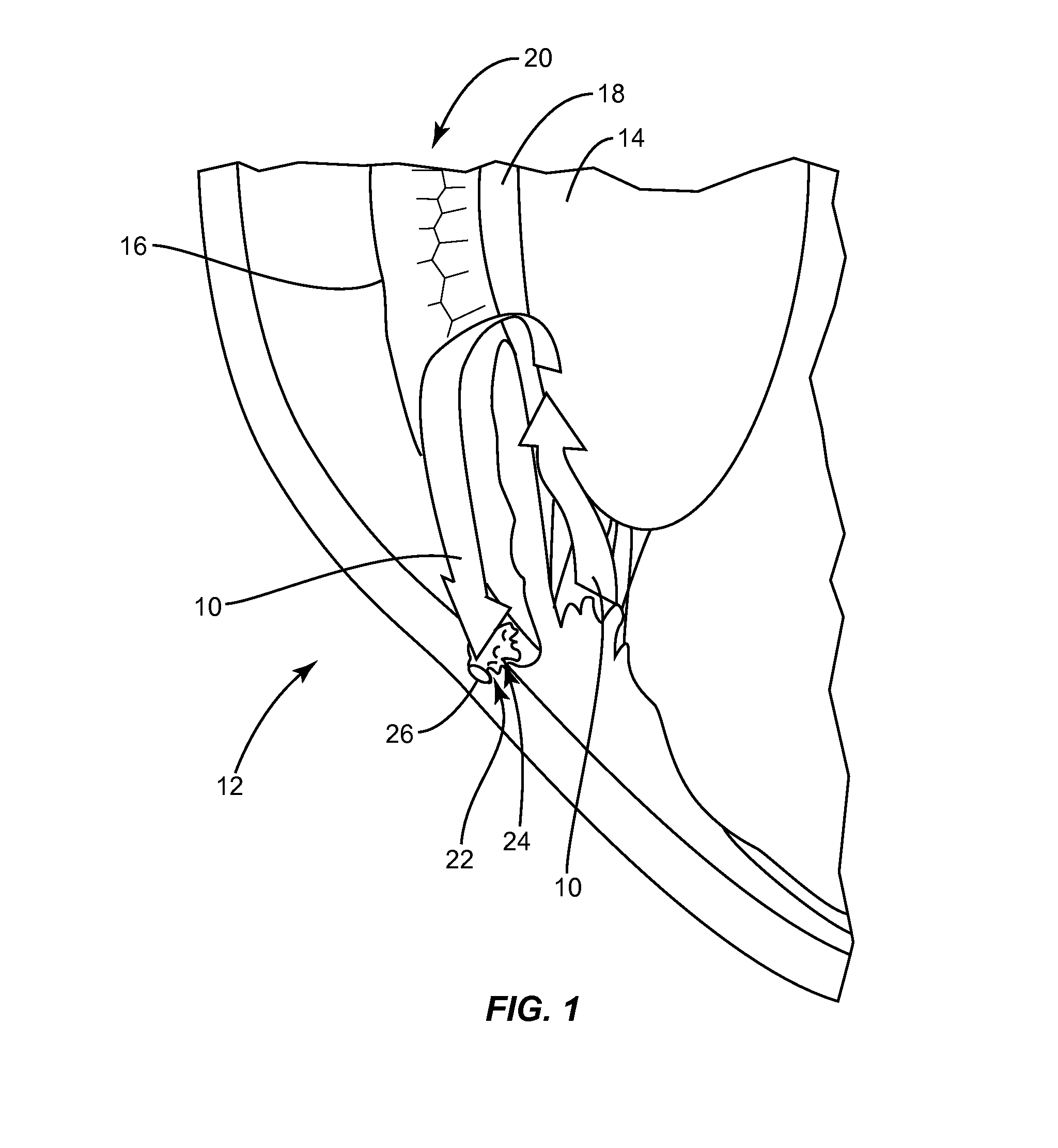 Methods, apparatuses, and systems for reducing intraocular pressure as a means of preventing or treating open-angle glaucoma