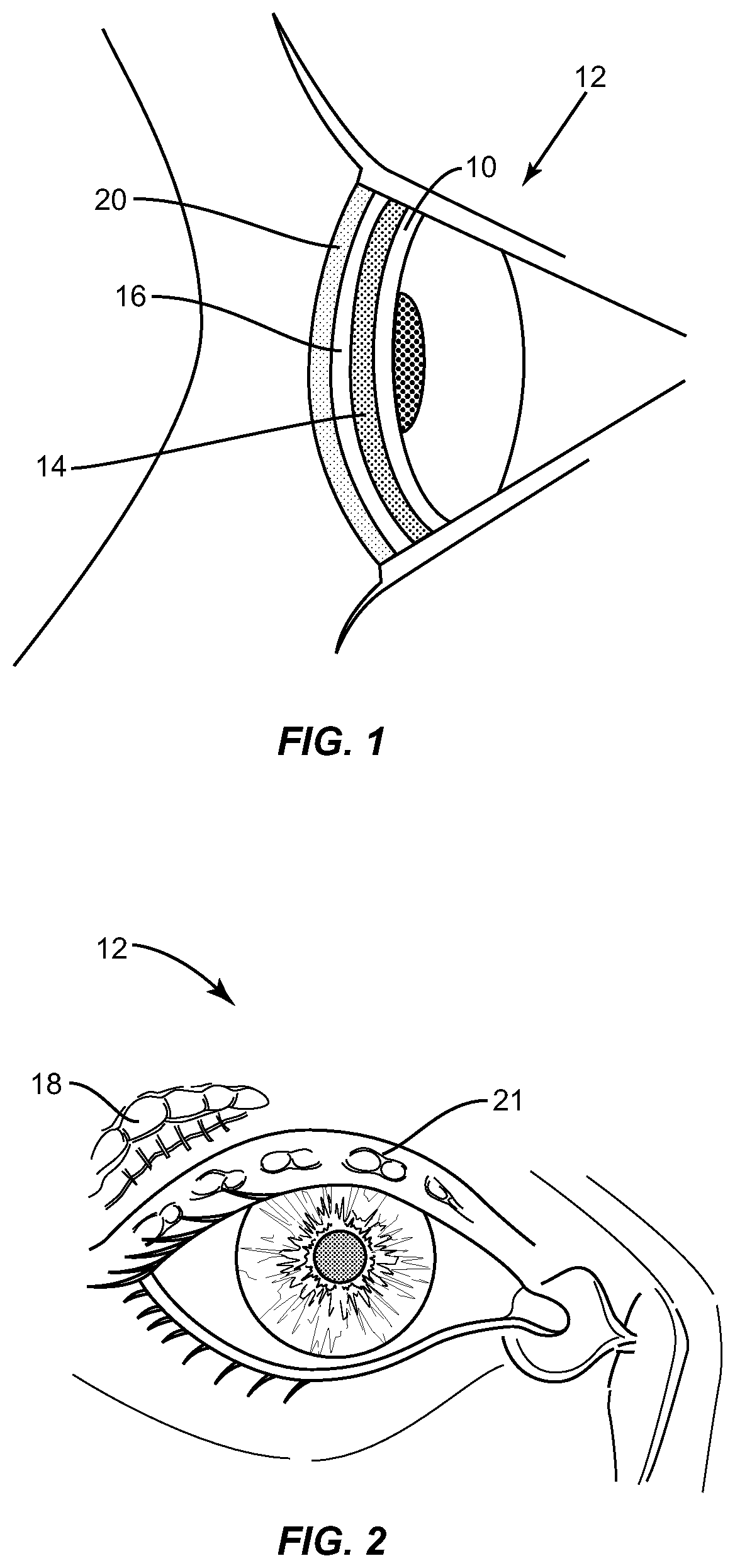 Apparatuses and methods for diagnosing and/or treating lipid transport deficiency in ocular tear films, and related components and devices