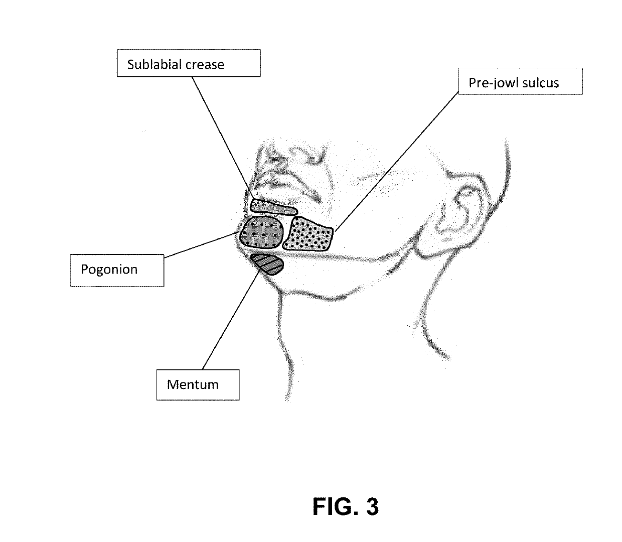 Implants for sculpting, augmenting or correcting facial features such as the chin